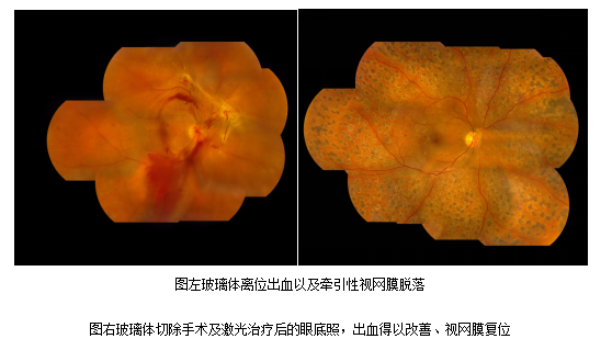 視網(wǎng)膜脫落的癥狀