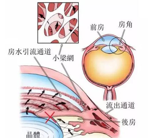 青光眼白內(nèi)障聯(lián)合術(shù)