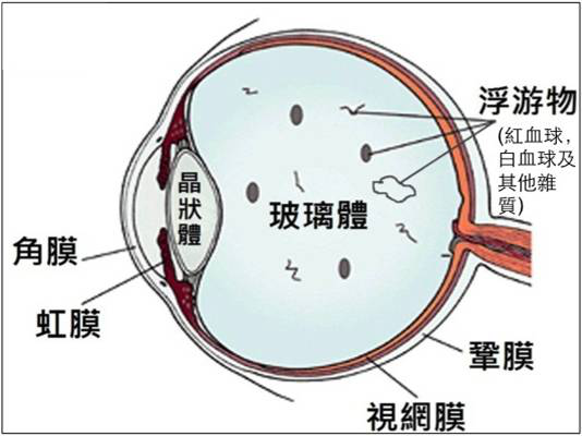 視網(wǎng)膜裂孔