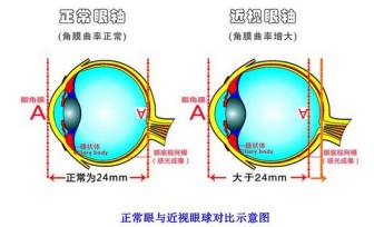 近視矯正辦法