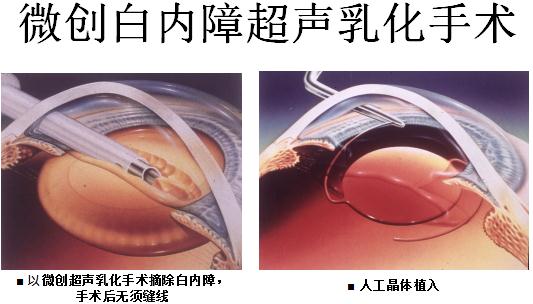 白內(nèi)障手術(shù)昆明哪家眼科醫(yī)院好