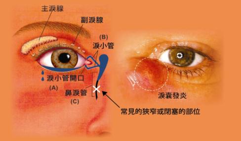 干眼癥怎么治療好