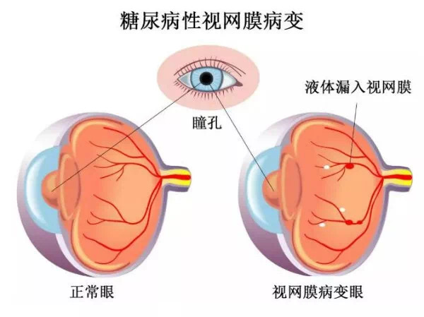 視網(wǎng)膜脫落怎么治療