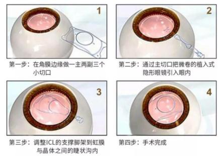 昆明icl手術(shù)多少錢？