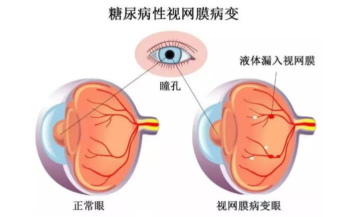 糖尿病視網(wǎng)膜病變怎么治療好得快？