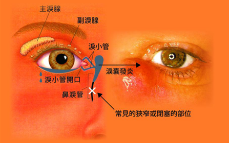 眼淚過多、眼睛紅是什么原因造成？