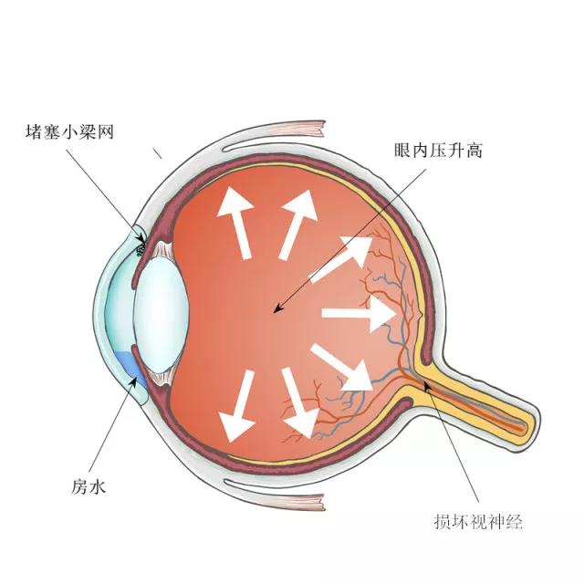 青光眼可以治好嗎？