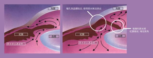 急性青光眼和慢性青光眼的區(qū)別