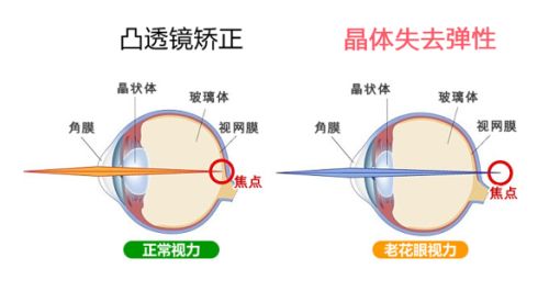 老花眼